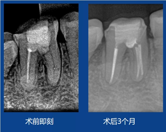 劉杰老師案例——髓室底穿孔修復(fù)