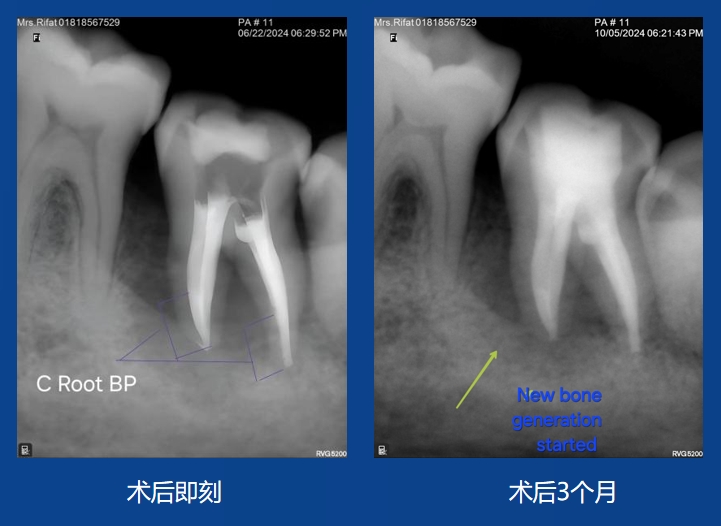 Sazzad Ur Rahman 老師案例——根吸收修復(fù)及充填