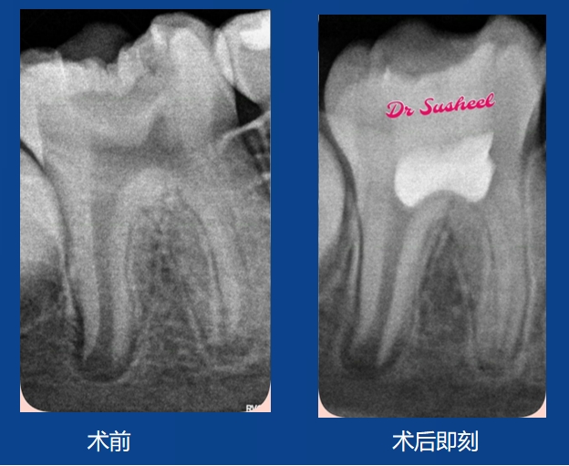 Susheel老師案例——活切直接蓋髓